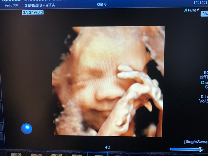 Scan Fetal